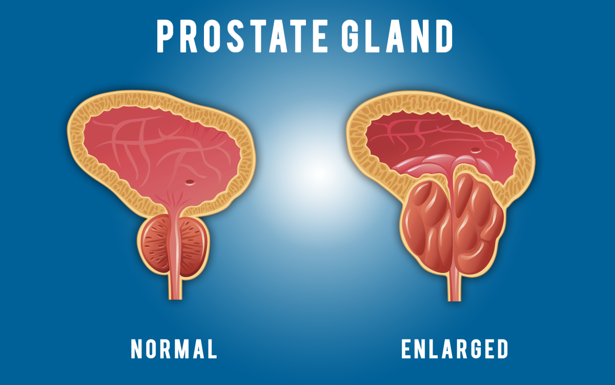 Prostate Health: What You Should be Checking for Every Decade.