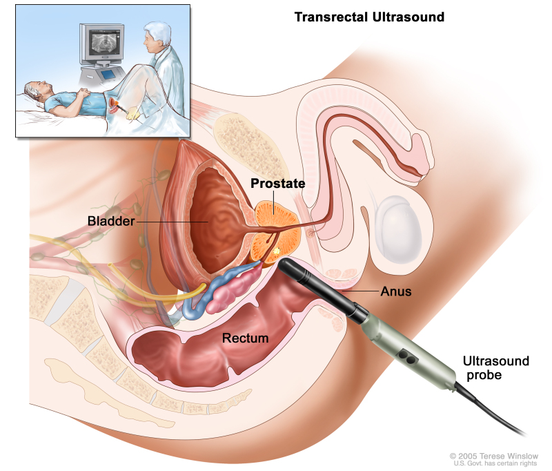 A Prostate Diary - Chapter 2.