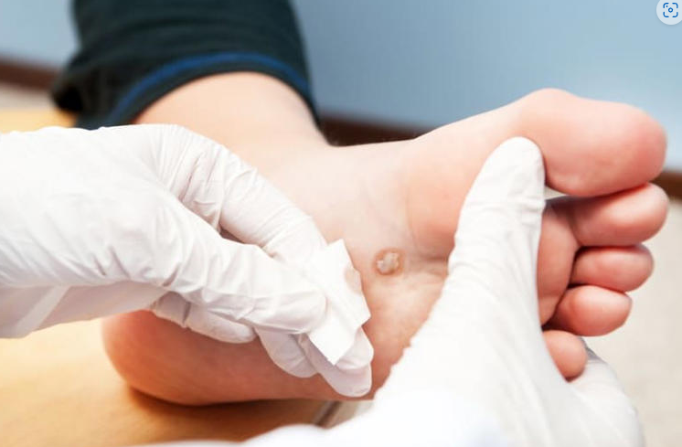 14 Symptoms of Type 2 Diabetes in the Feet That Can Lead to Amputation.