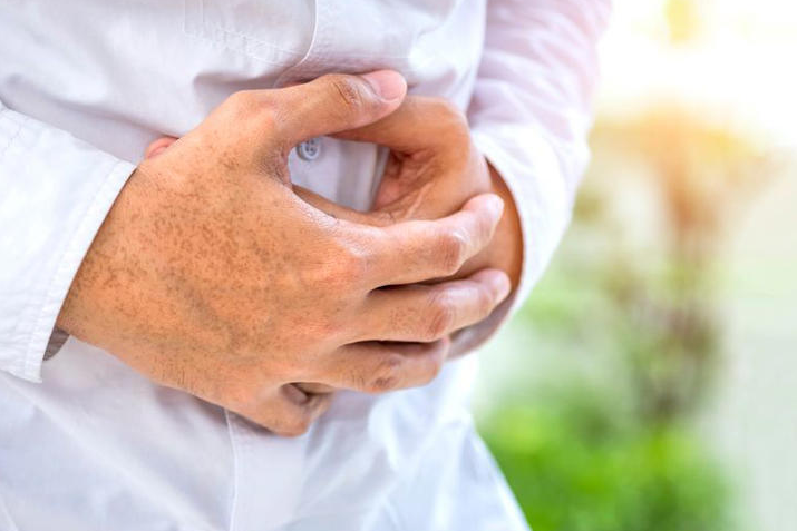 Bowel Cancer: Key symptoms to look out for as only 1 in 4 Brits able to identify warning signs.